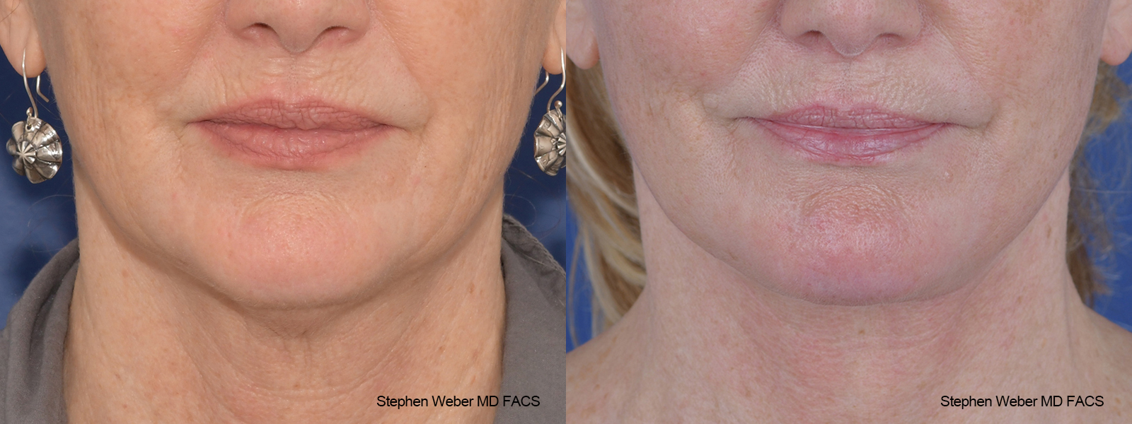 Facelift Before and After | Weber Facial Plastic Surgery