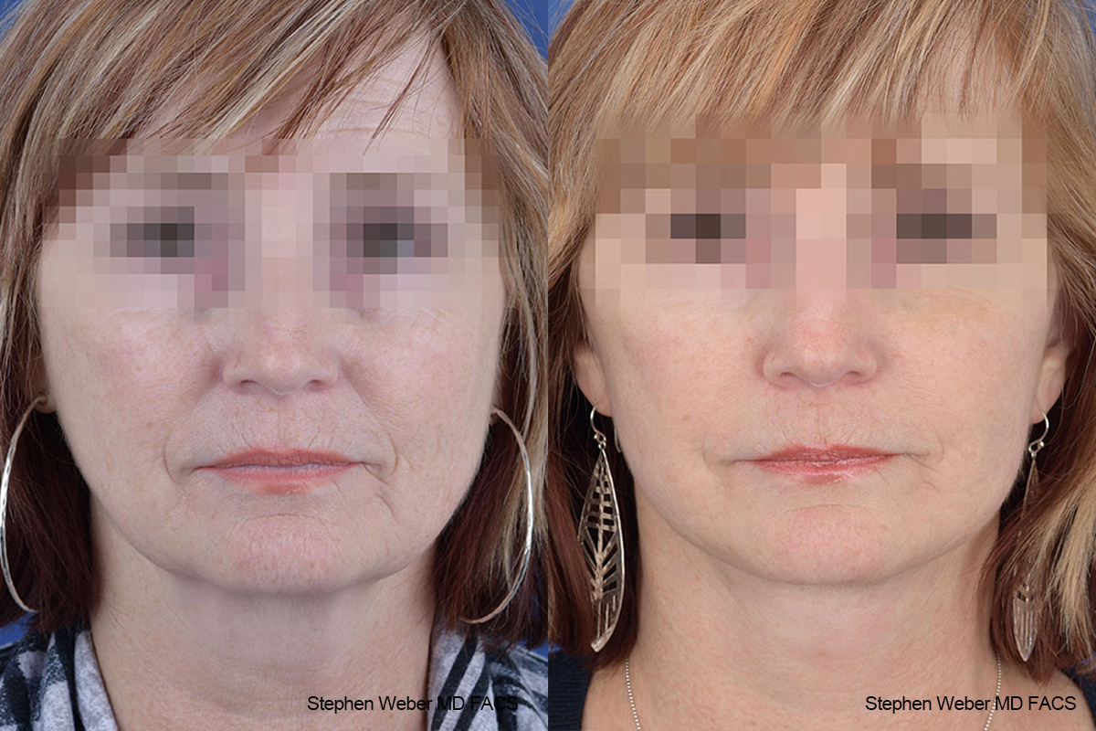 Facelift Before and After | Weber Facial Plastic Surgery