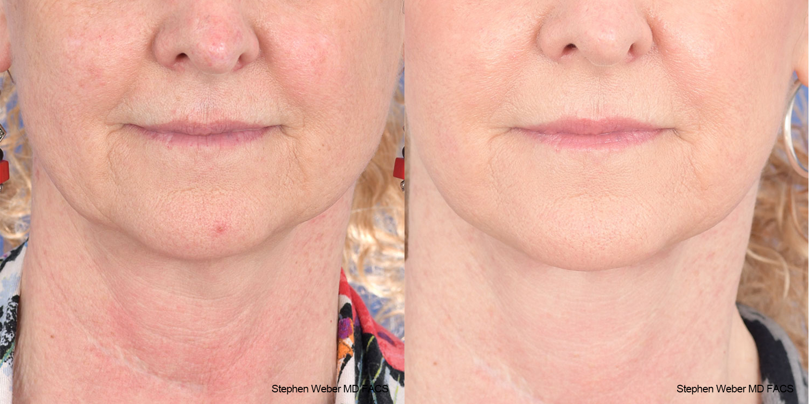 Facelift Before and After | Weber Facial Plastic Surgery