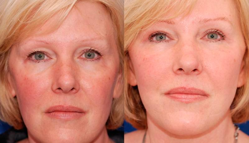 Facelift Before and After | Weber Facial Plastic Surgery
