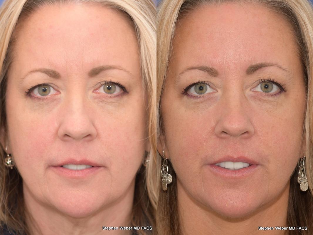 Facelift Before and After | Weber Facial Plastic Surgery