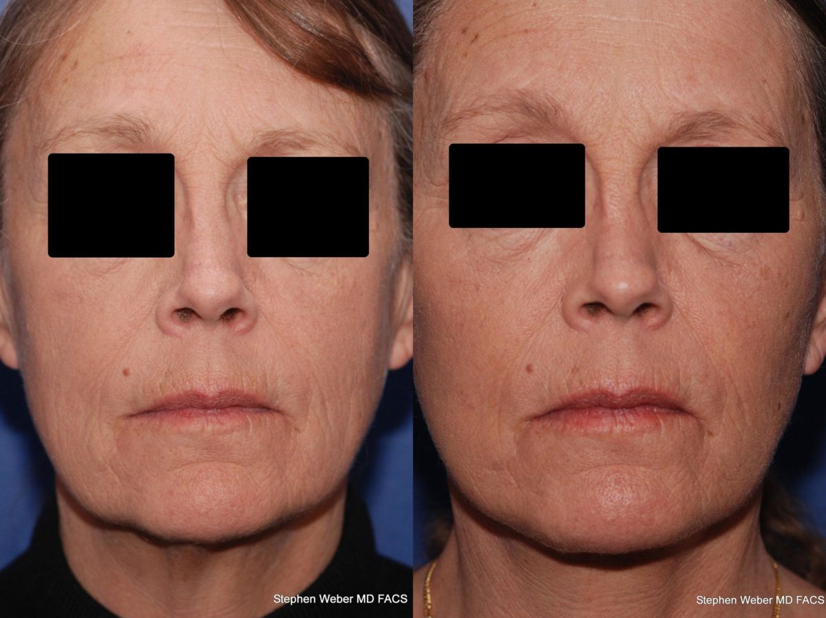 Facelift Before and After | Weber Facial Plastic Surgery
