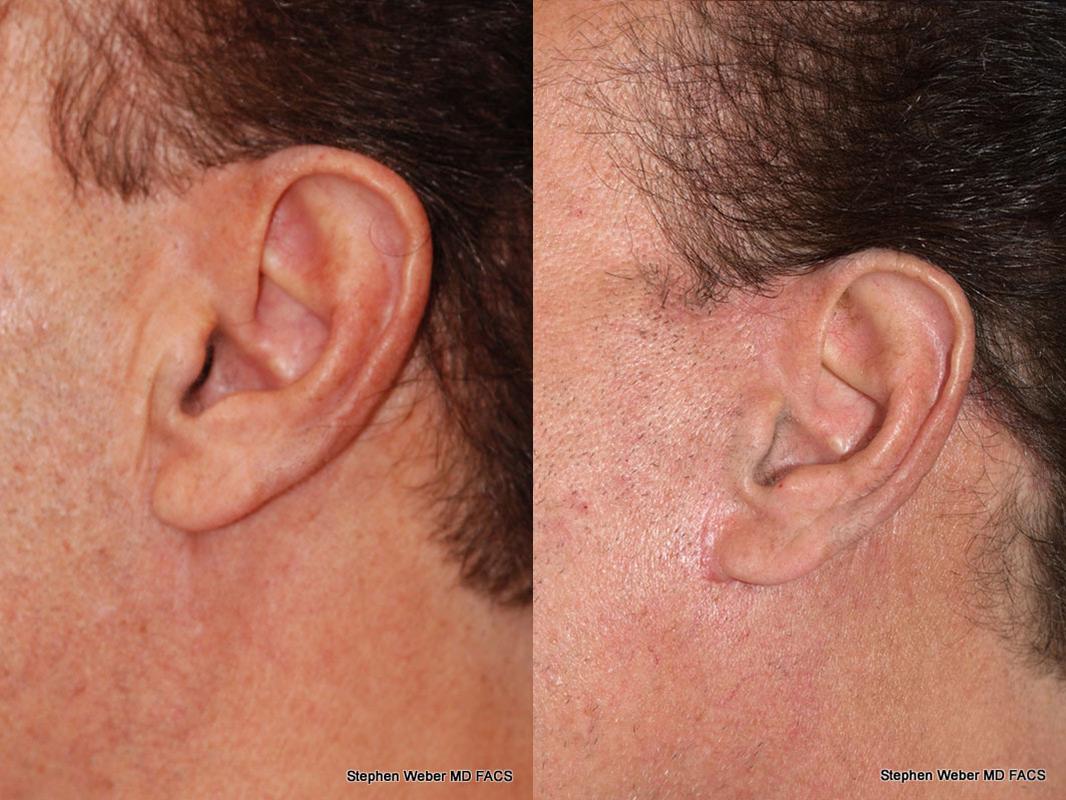 Facelift Before and After | Weber Facial Plastic Surgery