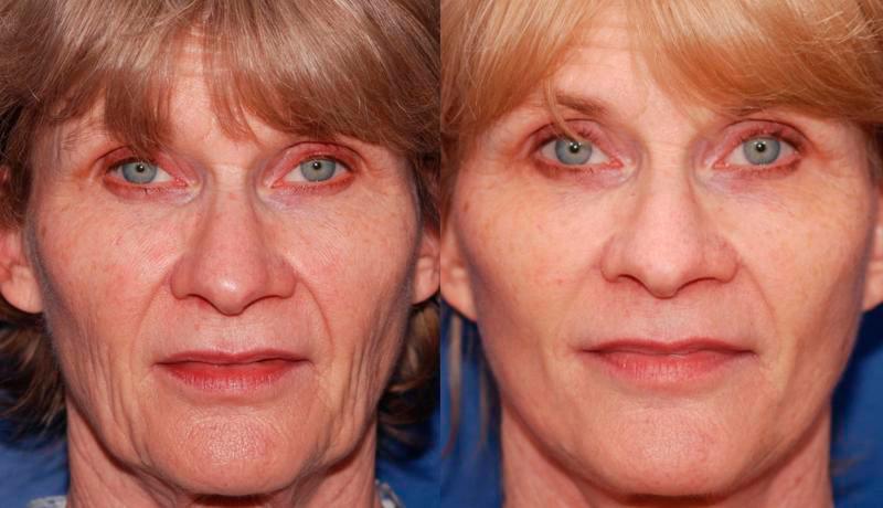 Facelift Before and After | Weber Facial Plastic Surgery