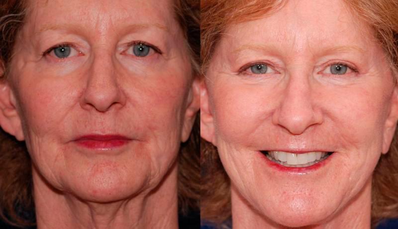Facelift Before and After | Weber Facial Plastic Surgery
