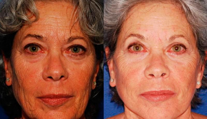 Facelift Before and After | Weber Facial Plastic Surgery
