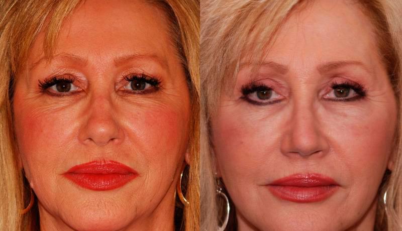 Facelift Before and After | Weber Facial Plastic Surgery