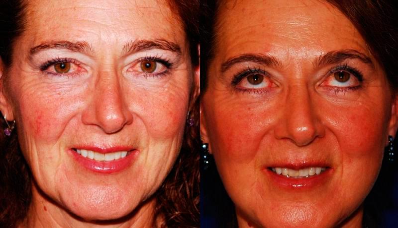 Facelift Before and After | Weber Facial Plastic Surgery