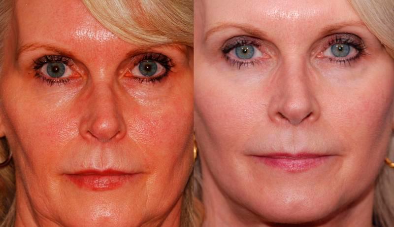 Facelift Before and After | Weber Facial Plastic Surgery