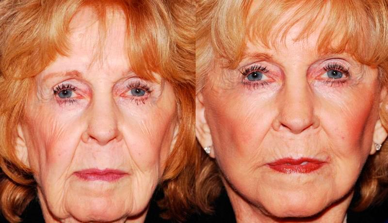 Facelift Before and After | Weber Facial Plastic Surgery