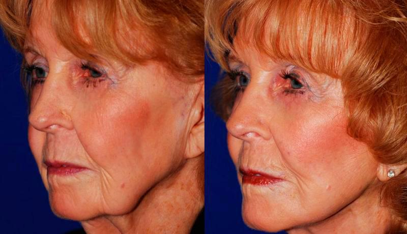 Facelift Before and After | Weber Facial Plastic Surgery