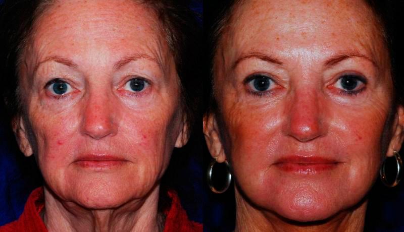 Facelift Before and After | Weber Facial Plastic Surgery