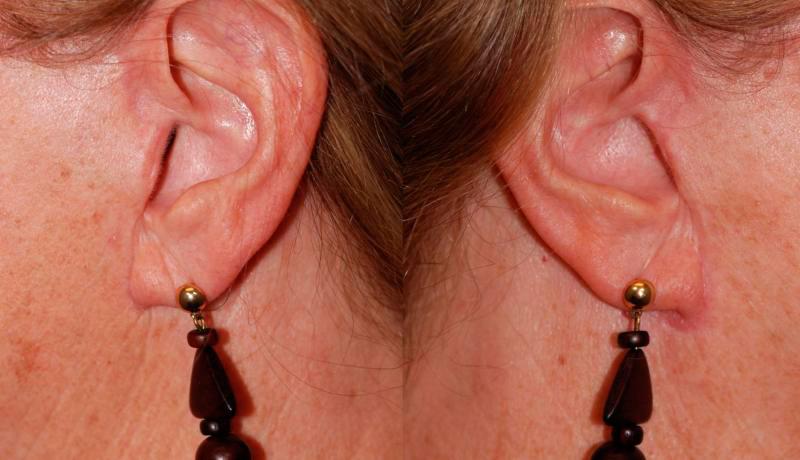 Facelift Before and After | Weber Facial Plastic Surgery