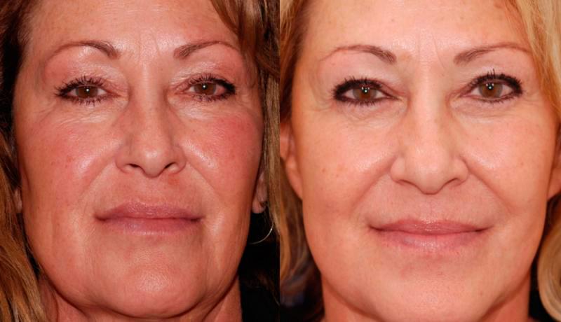 Facelift Before and After | Weber Facial Plastic Surgery