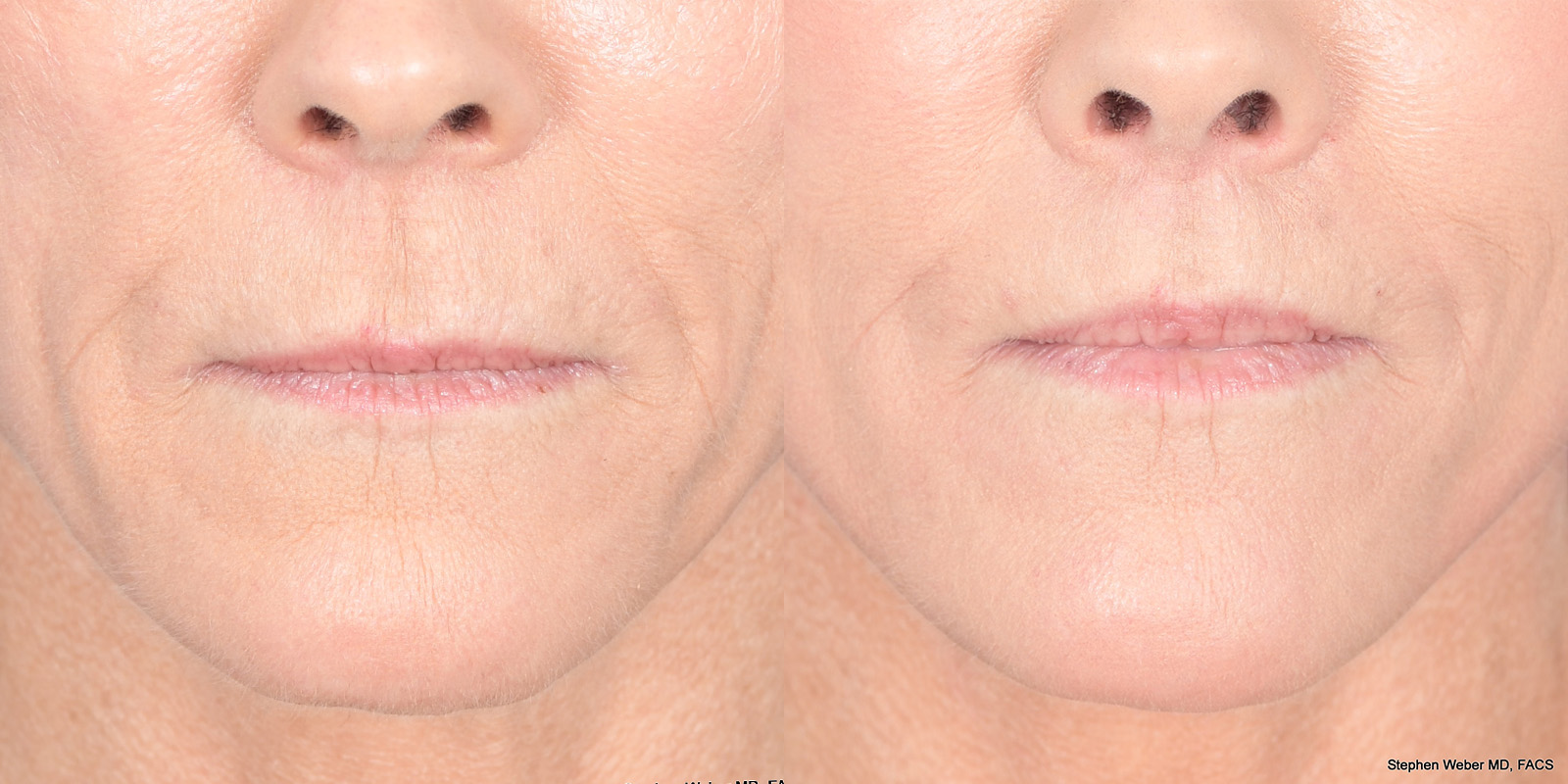 Lip Lift Before and After | Weber Facial Plastic Surgery