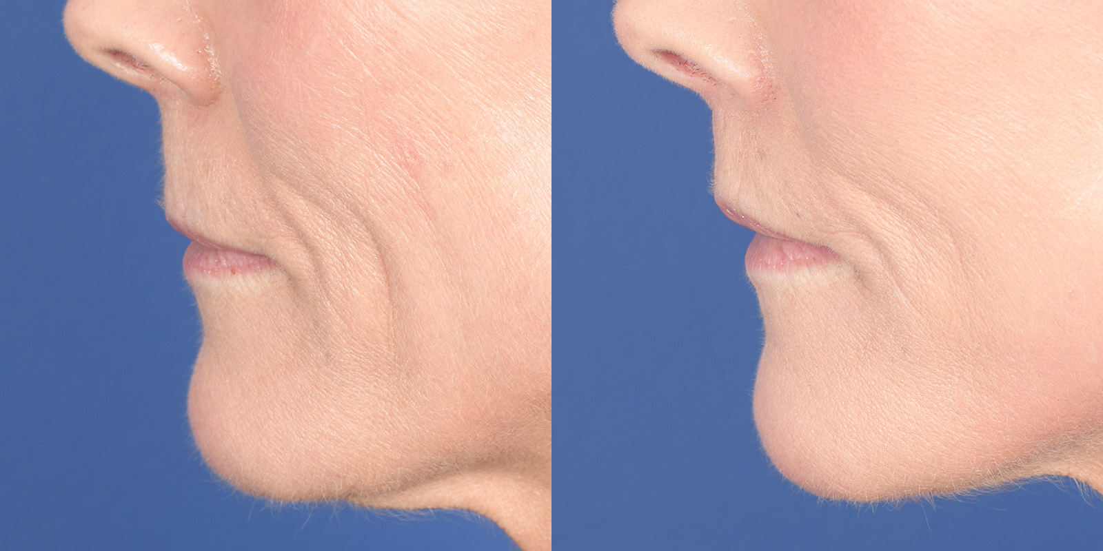 Lip Lift Before and After | Weber Facial Plastic Surgery