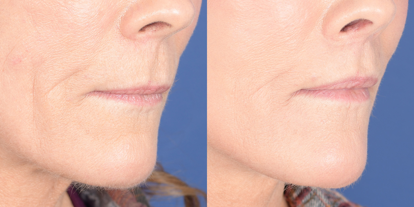 Lip Lift Before and After | Weber Facial Plastic Surgery