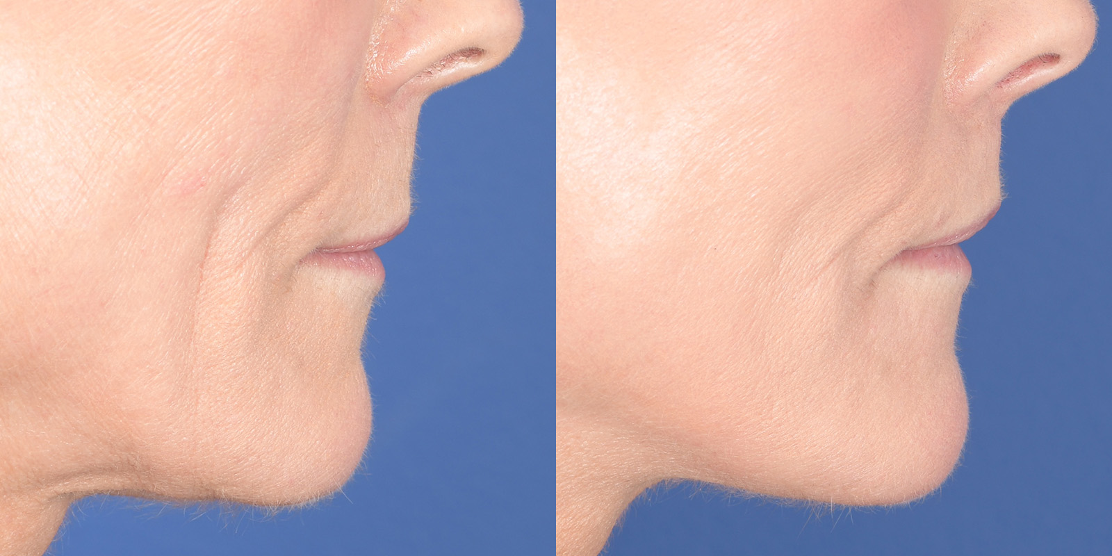 Lip Lift Before and After | Weber Facial Plastic Surgery