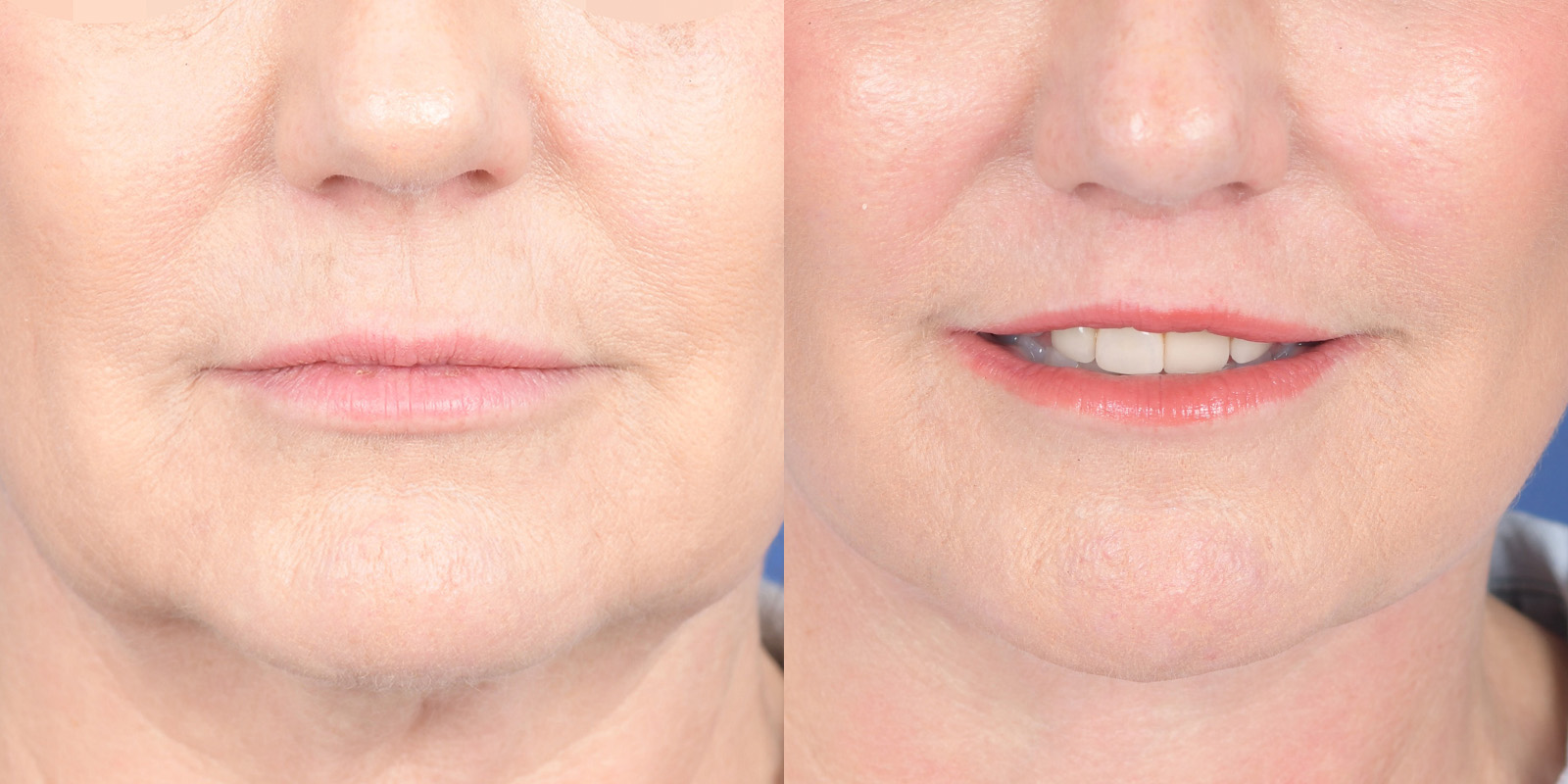 Lip Lift Before and After | Weber Facial Plastic Surgery