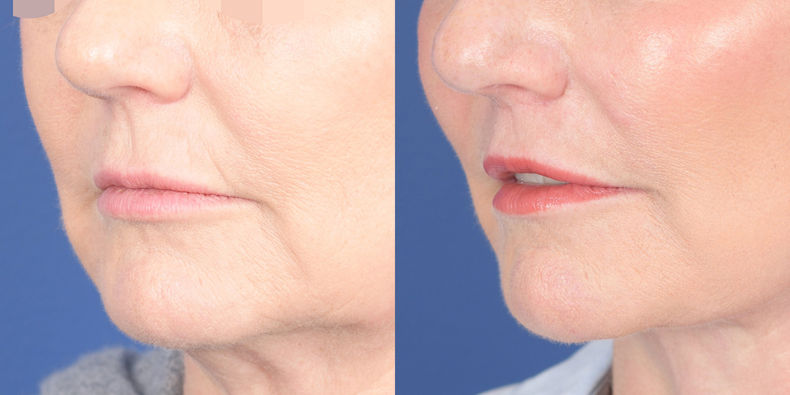 Lip Lift Before and After | Weber Facial Plastic Surgery