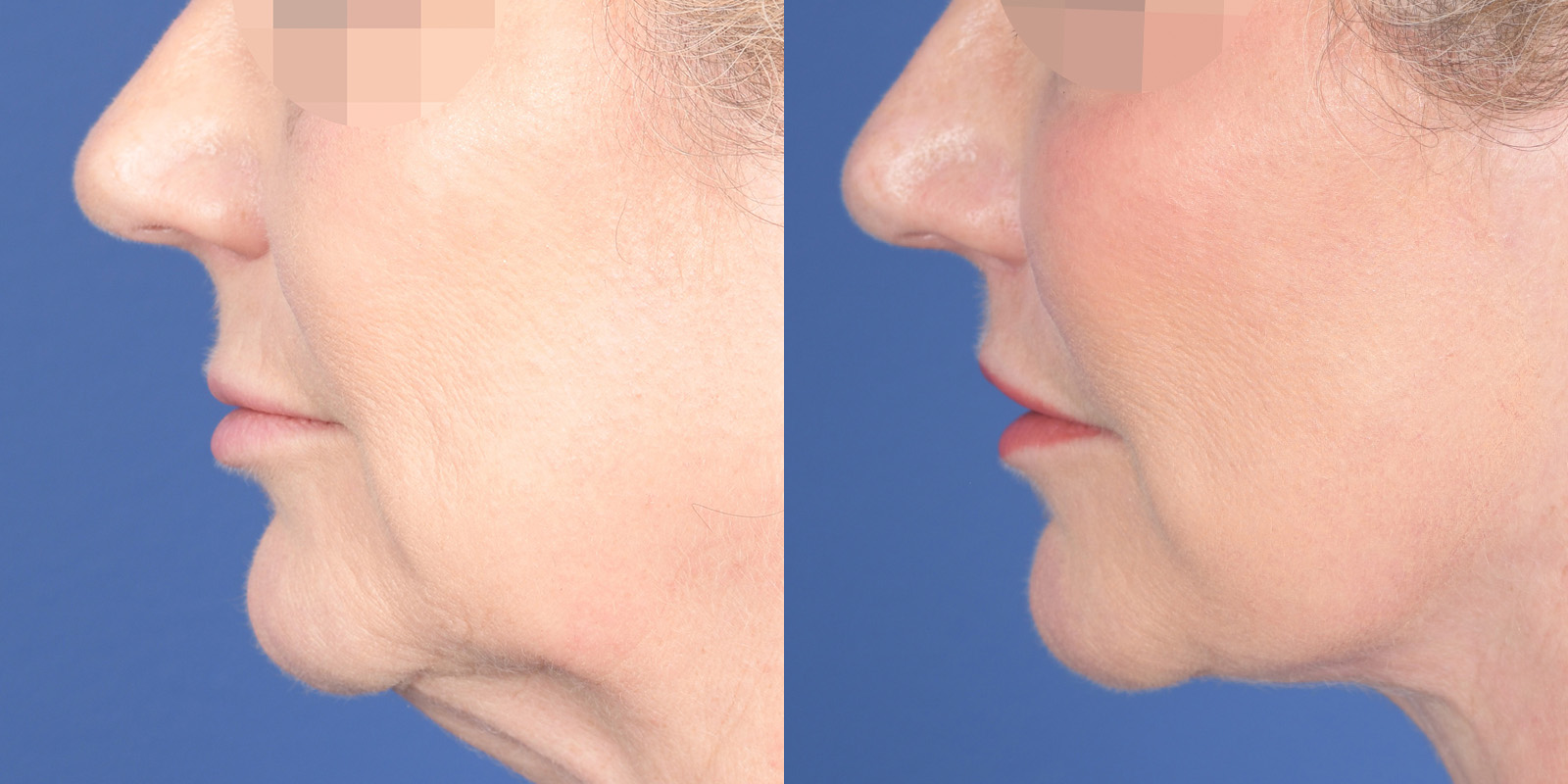 Lip Lift Before and After | Weber Facial Plastic Surgery