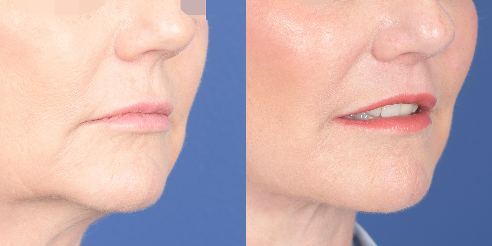 Lip Lift Before and After | Weber Facial Plastic Surgery