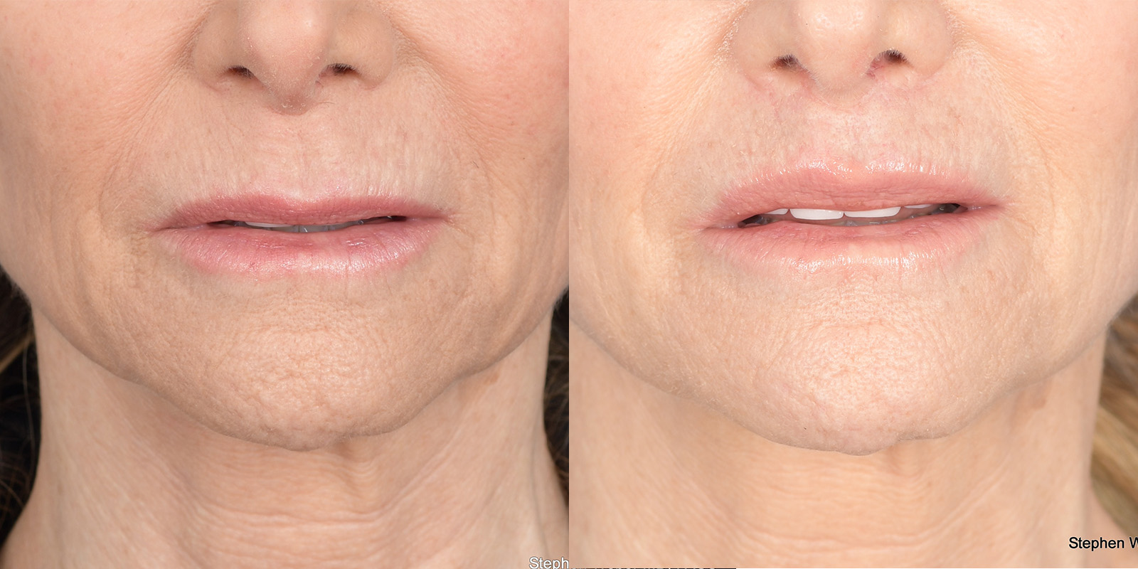 Lip Lift Before and After | Weber Facial Plastic Surgery