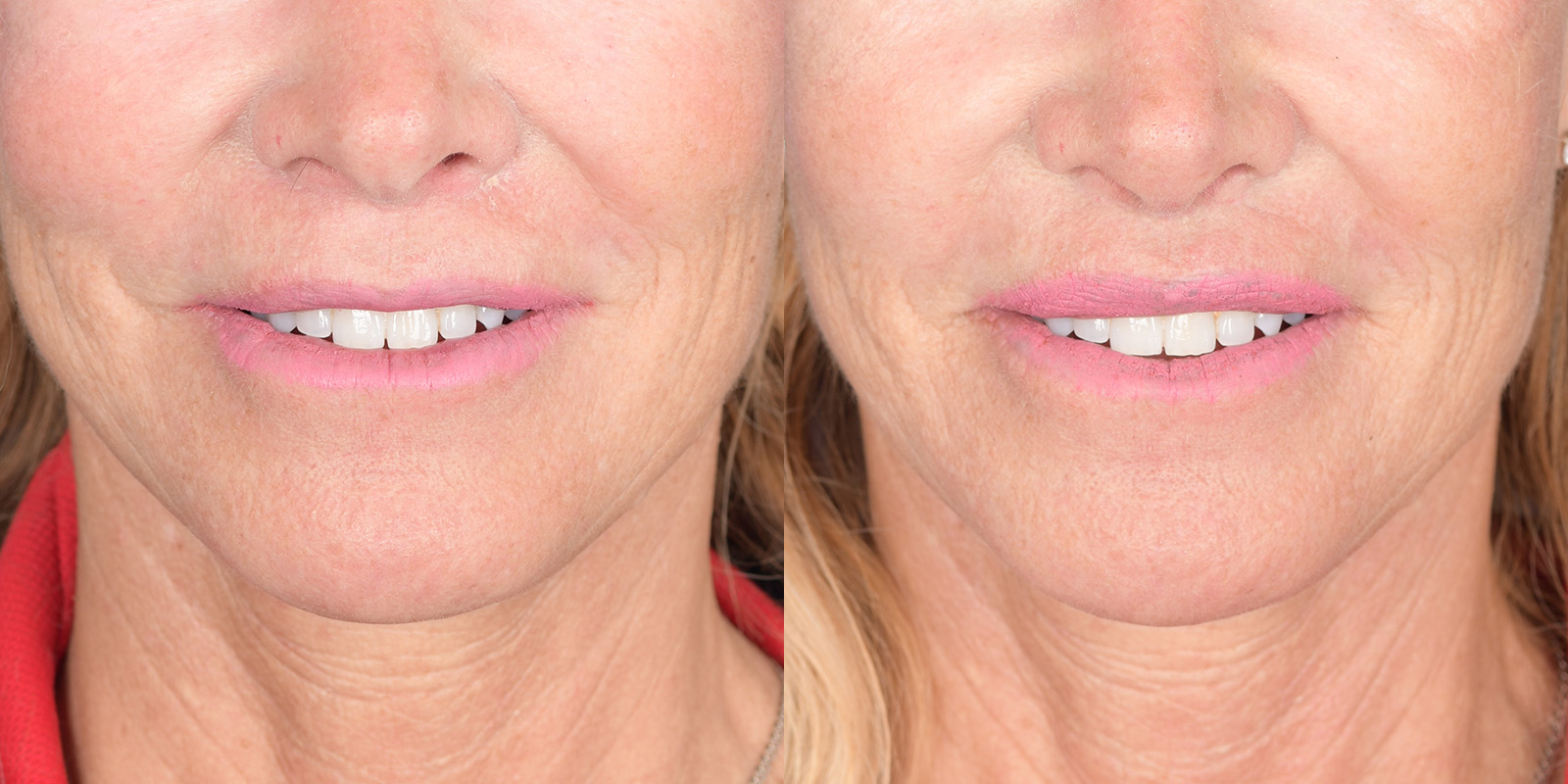 Lip Lift Before and After | Weber Facial Plastic Surgery