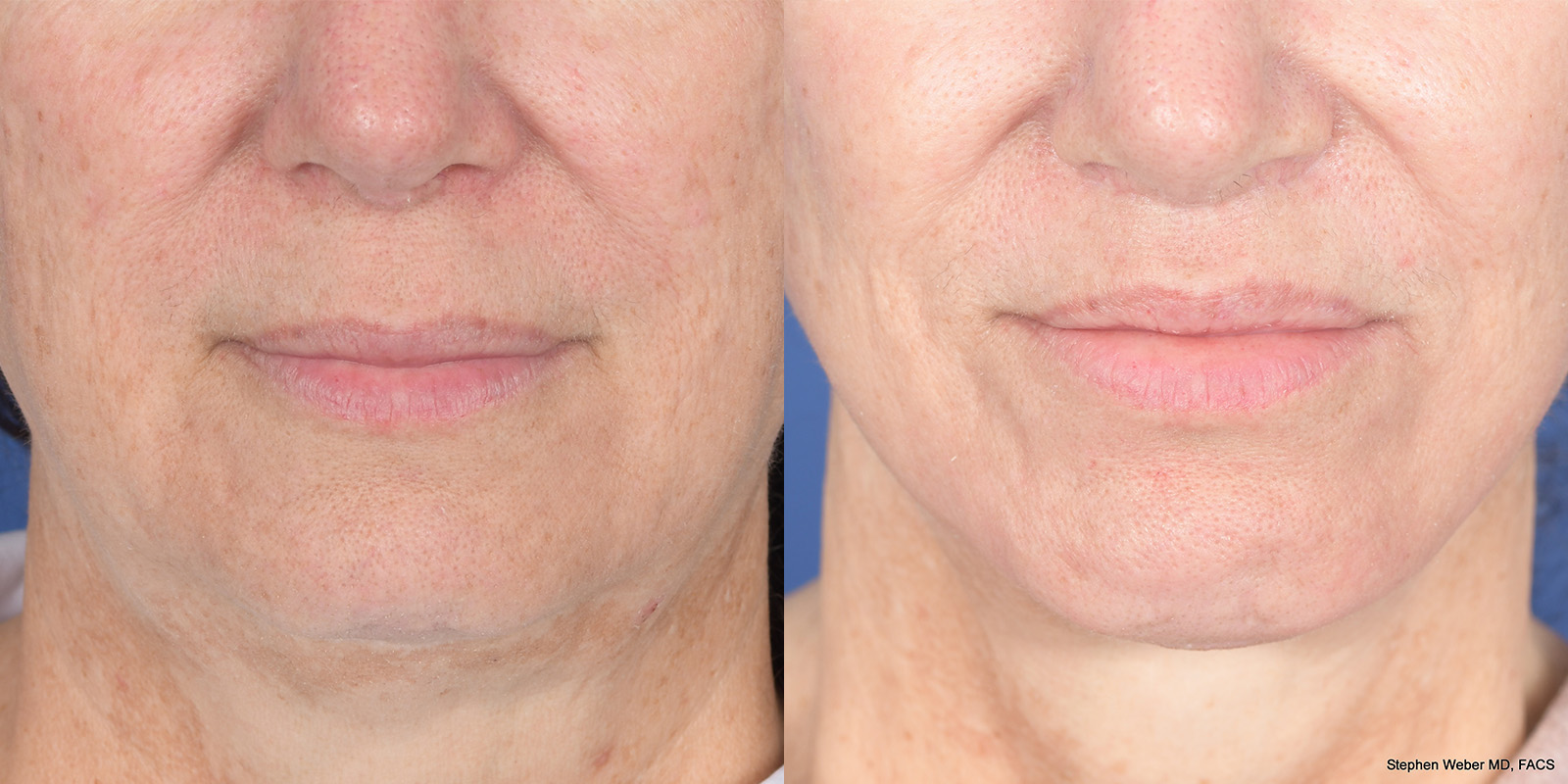 Lip Lift Before and After | Weber Facial Plastic Surgery