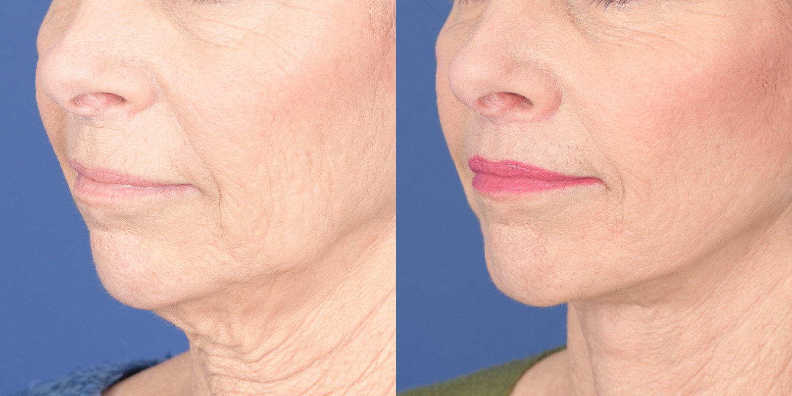 Lip Lift Before and After | Weber Facial Plastic Surgery