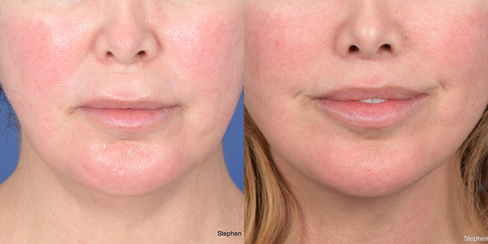 Lip Lift Before and After | Weber Facial Plastic Surgery