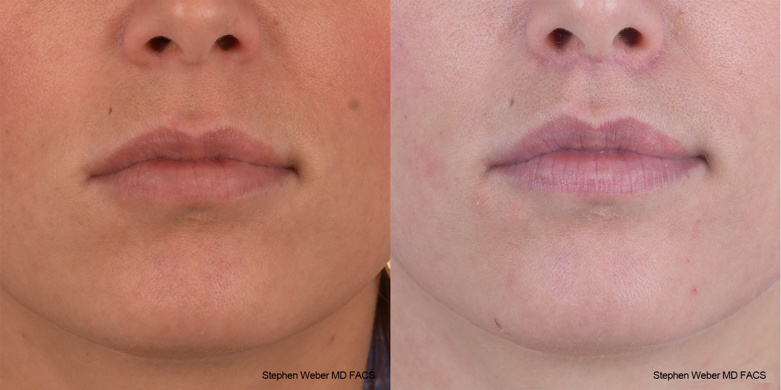 Lip Lift Before and After | Weber Facial Plastic Surgery