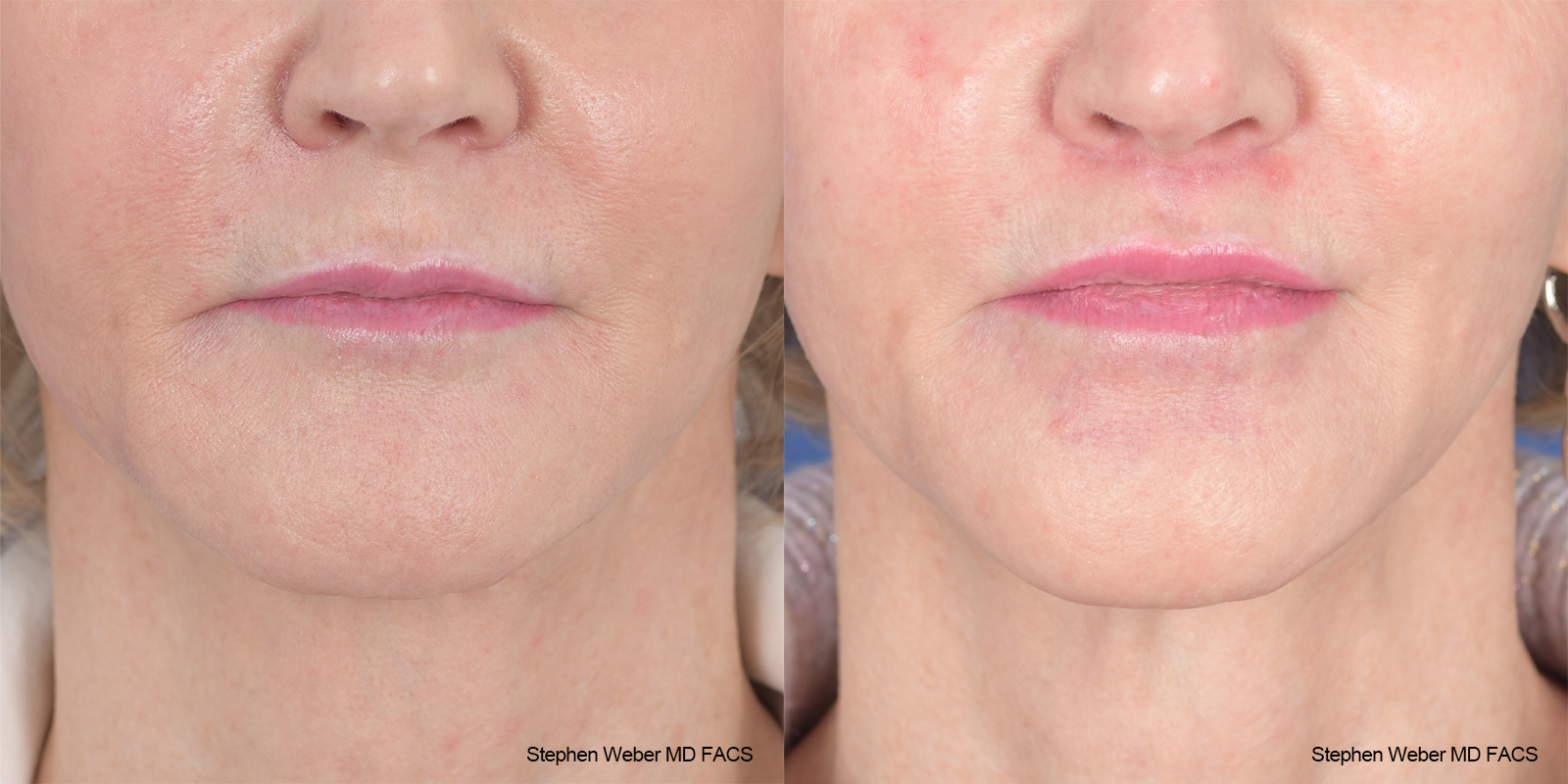 Lip Lift Before and After | Weber Facial Plastic Surgery