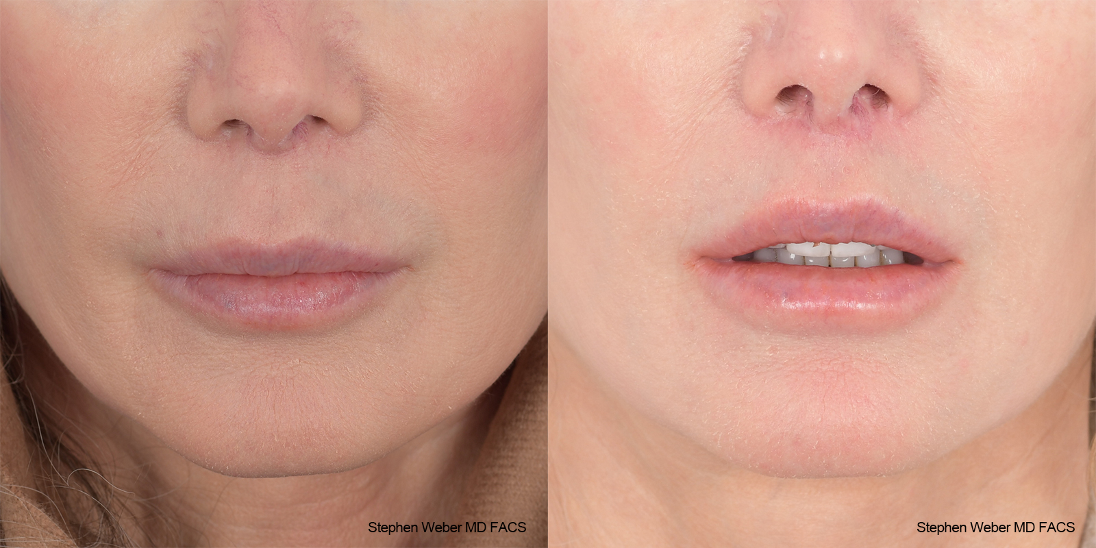 Lip Lift Before and After | Weber Facial Plastic Surgery
