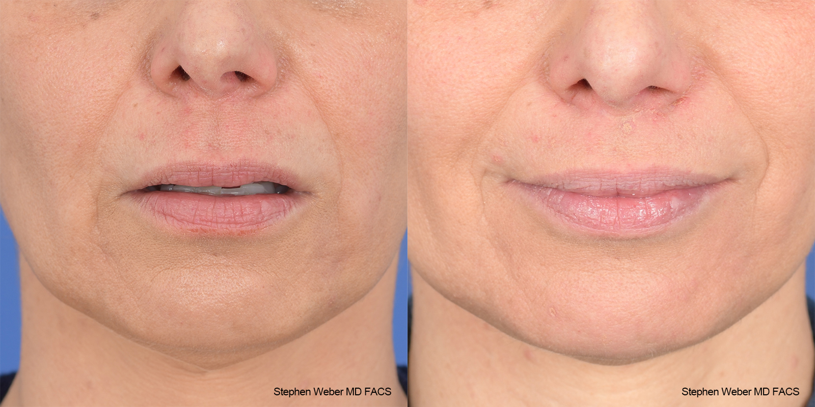 Lip Lift Before and After | Weber Facial Plastic Surgery