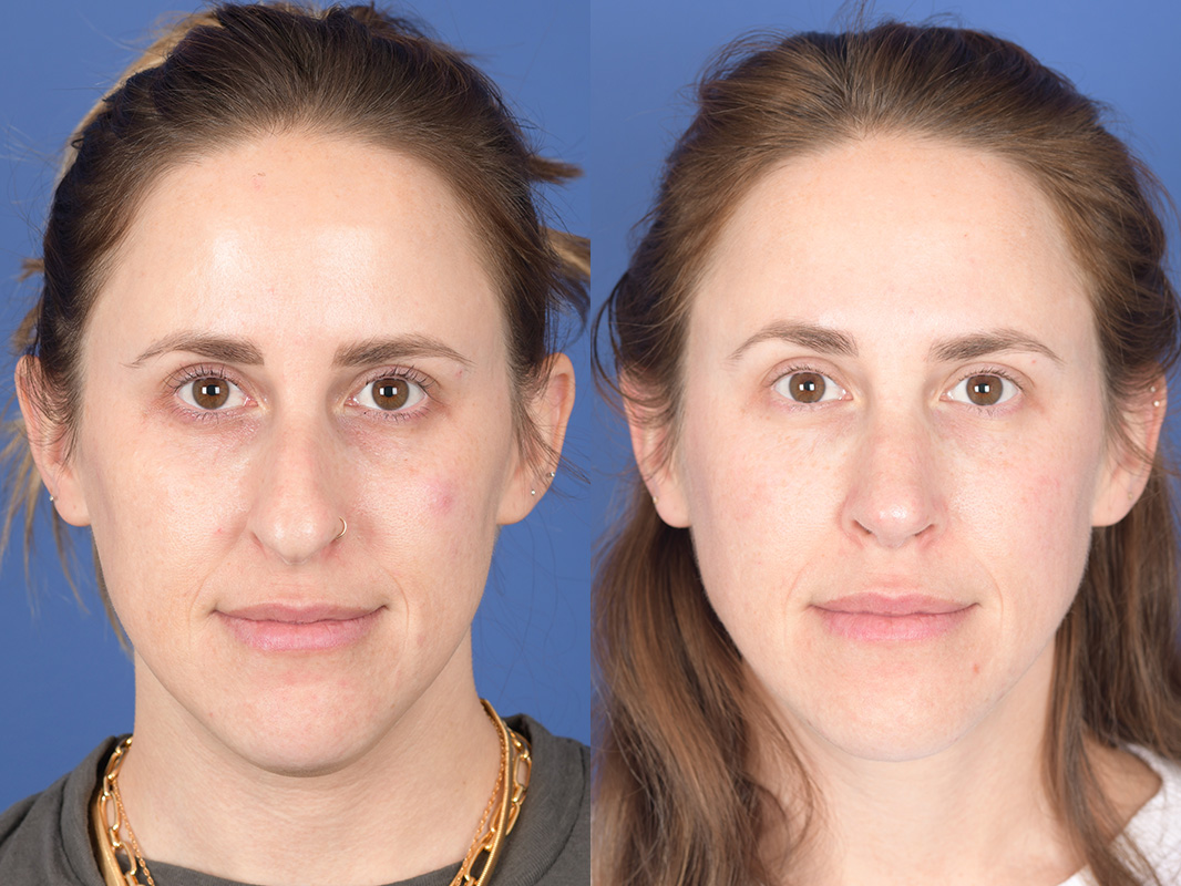 Before and After Neck Liposuction in Denver 1