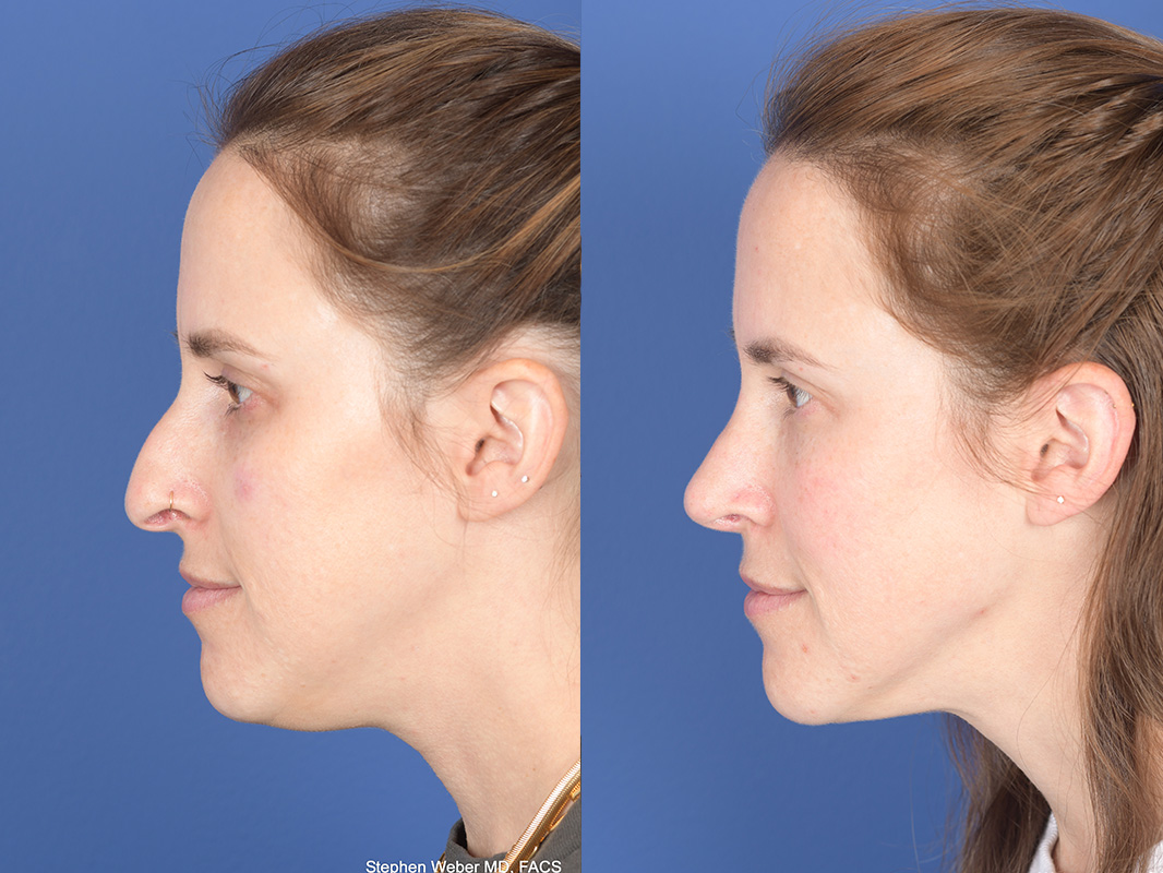 Liposuction Before and After | Weber Facial Plastic Surgery
