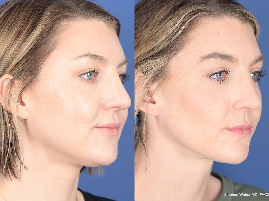 Liposuction Before and After | Weber Facial Plastic Surgery
