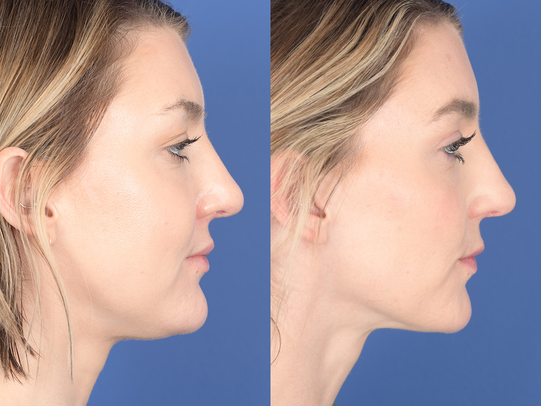 Liposuction Before and After | Weber Facial Plastic Surgery