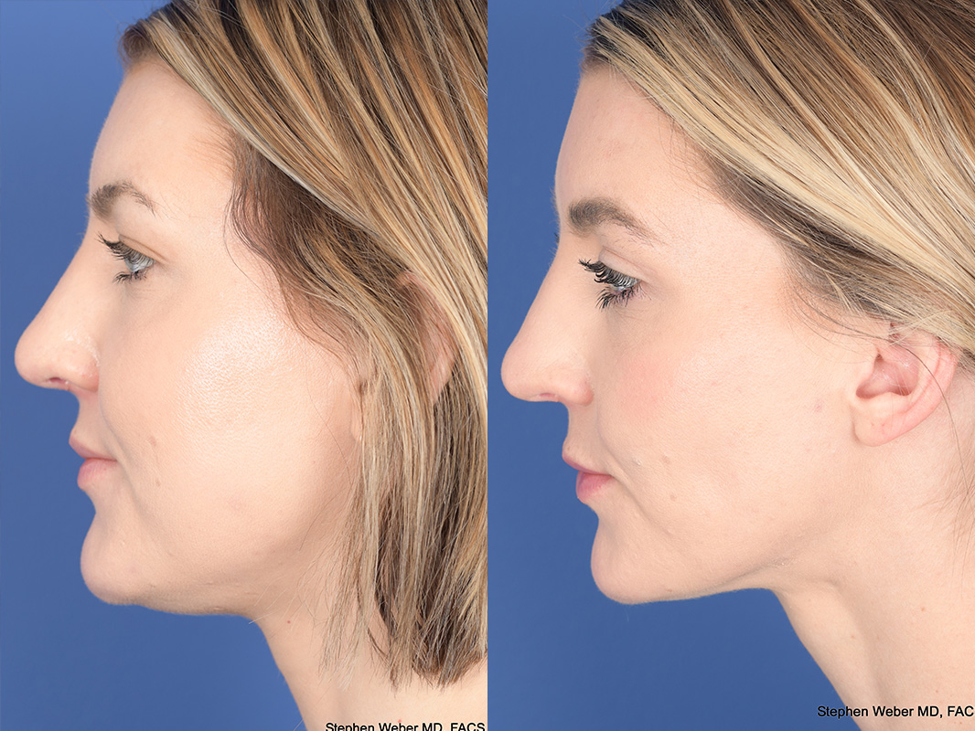 Liposuction Before and After | Weber Facial Plastic Surgery
