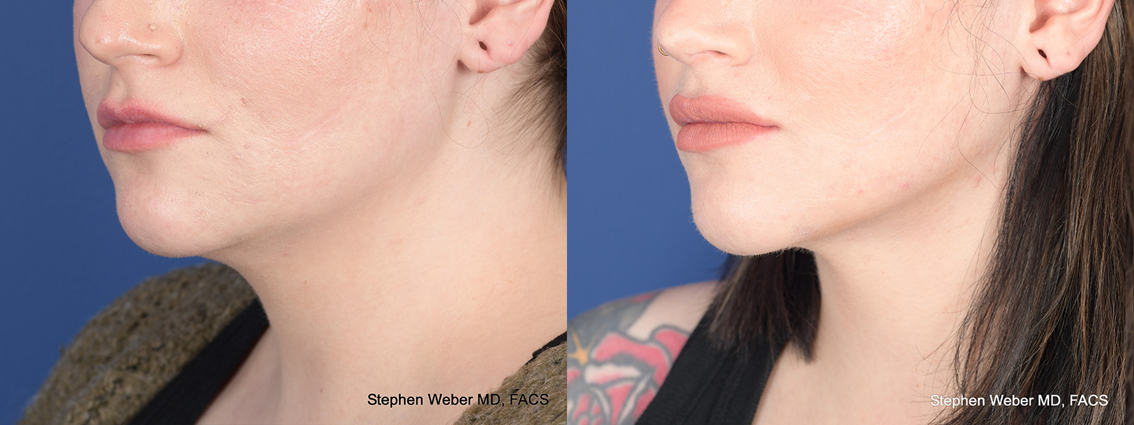 Liposuction Before and After | Weber Facial Plastic Surgery