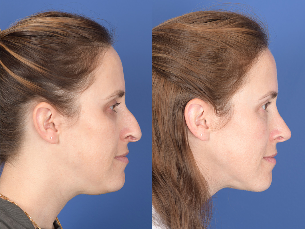 Liposuction Before and After | Weber Facial Plastic Surgery