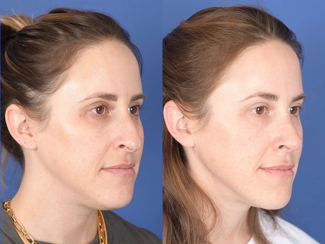 Liposuction Before and After | Weber Facial Plastic Surgery