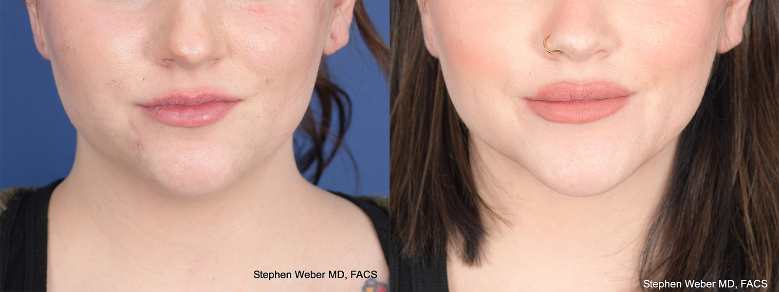Liposuction Before and After | Weber Facial Plastic Surgery
