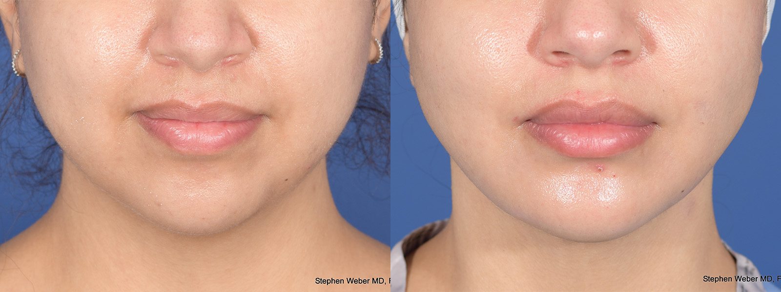 Liposuction Before and After | Weber Facial Plastic Surgery