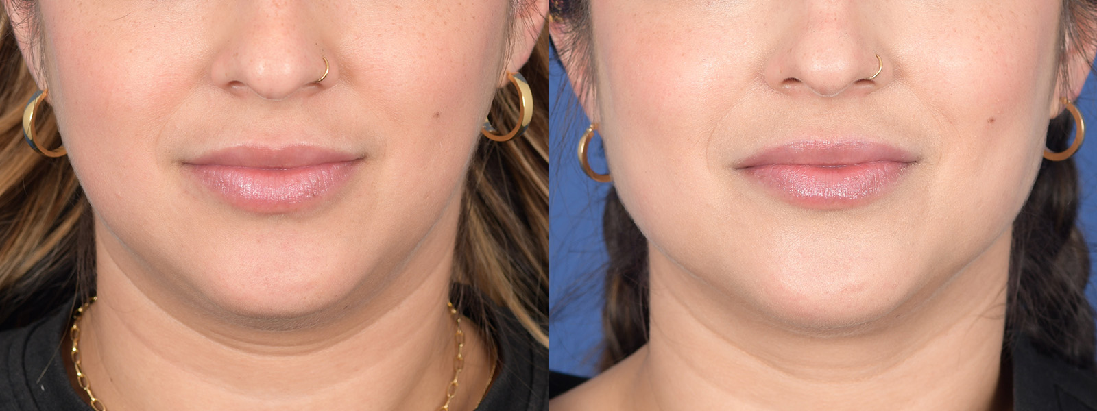 Liposuction Before and After | Weber Facial Plastic Surgery