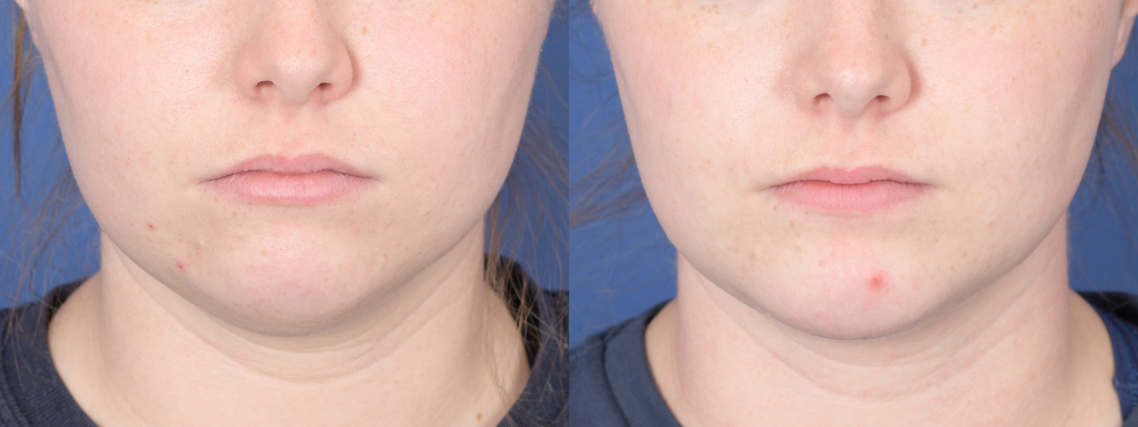 Liposuction Before and After | Weber Facial Plastic Surgery