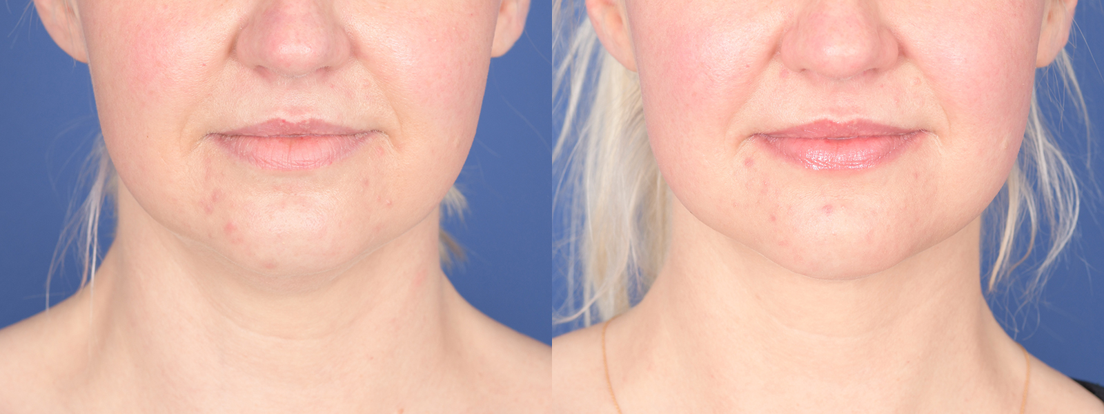 Liposuction Before and After | Weber Facial Plastic Surgery