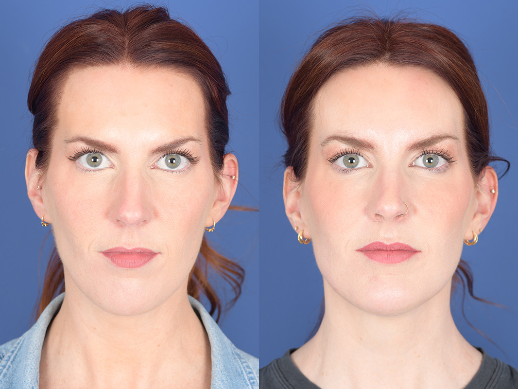 Necklift Before and After | Weber Facial Plastic Surgery