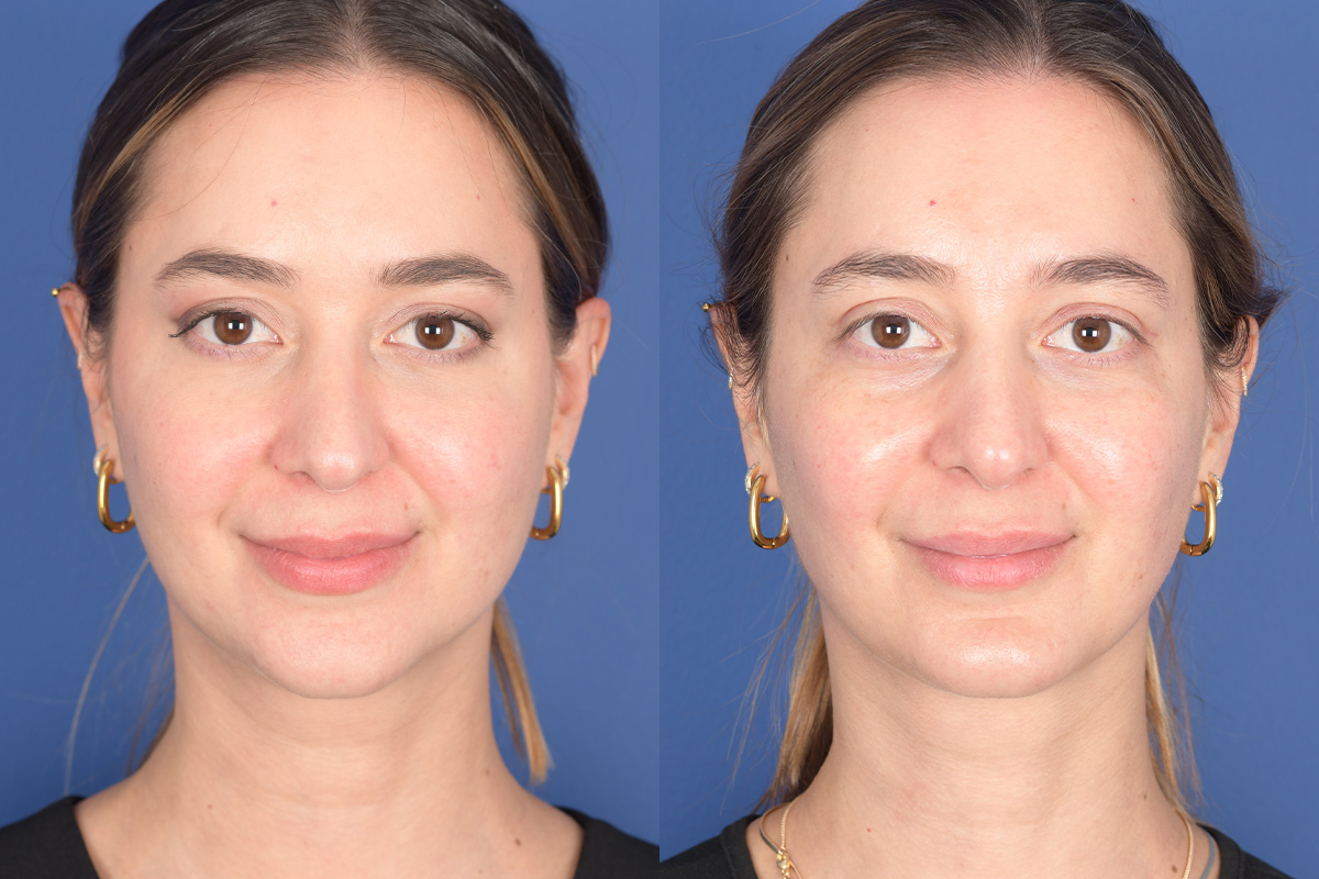 Necklift Before and After | Weber Facial Plastic Surgery
